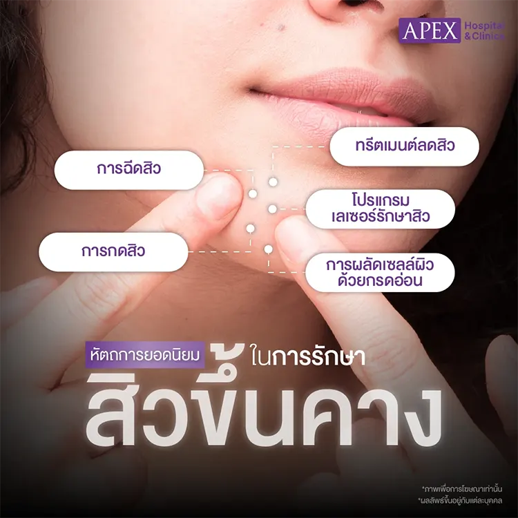 สิวขึ้นคาง