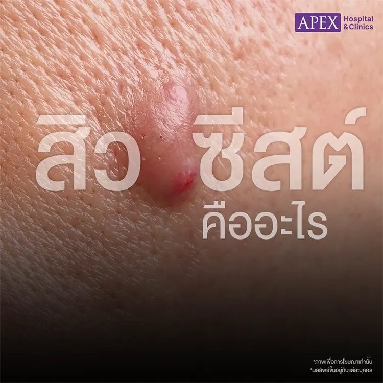 สิวซีสต์