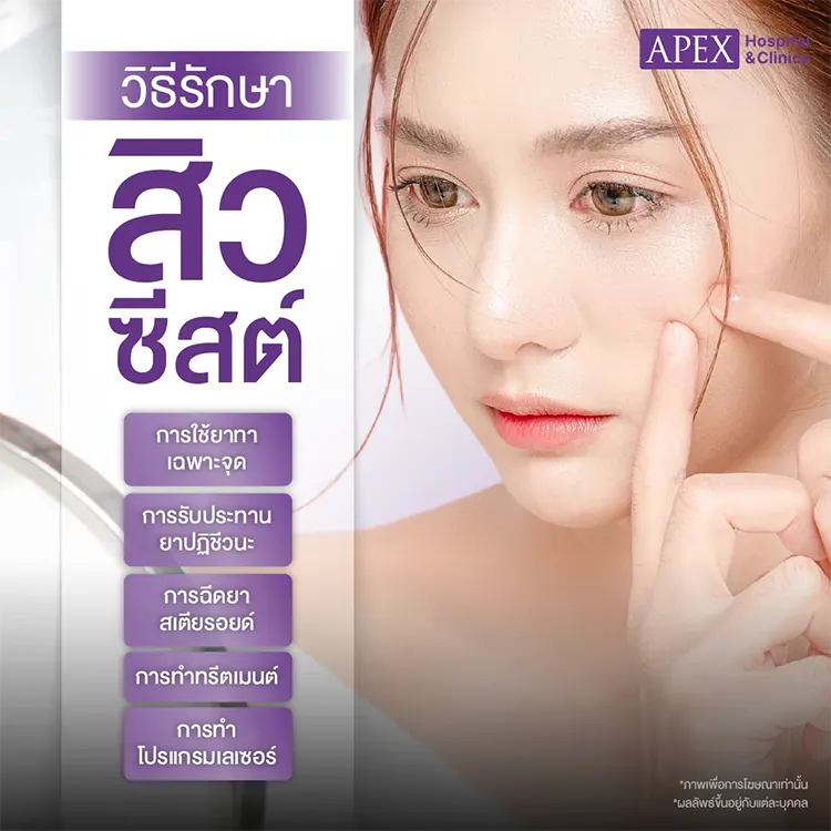 สิวซีสต์