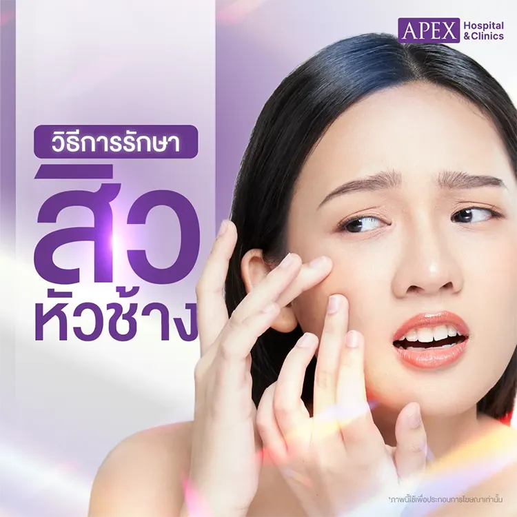 สิวหัวช้าง