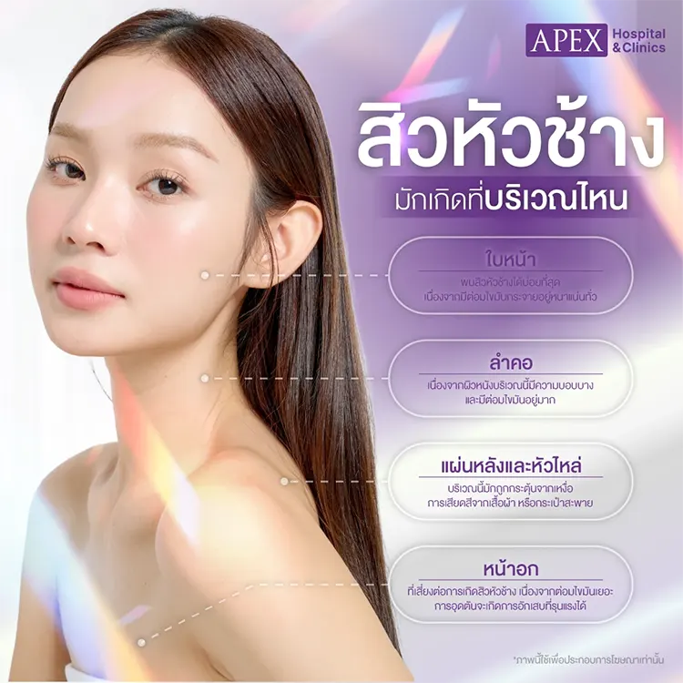 สิวหัวช้าง