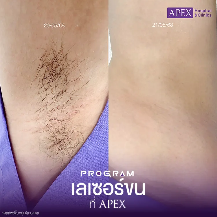 กำจัดขนรักแร้