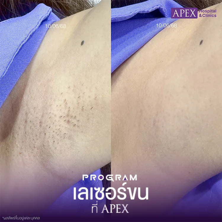 กำจัดขนรักแร้