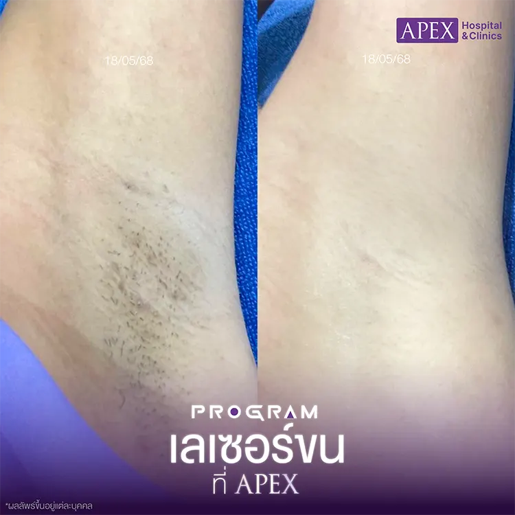 กำจัดขน