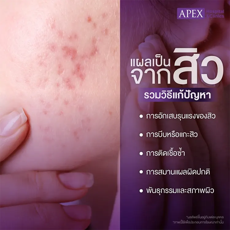 แผลเป็นจากสิว