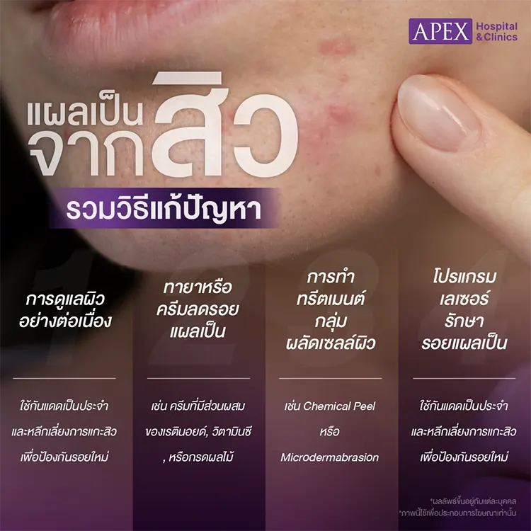 แผลเป็นจากสิว