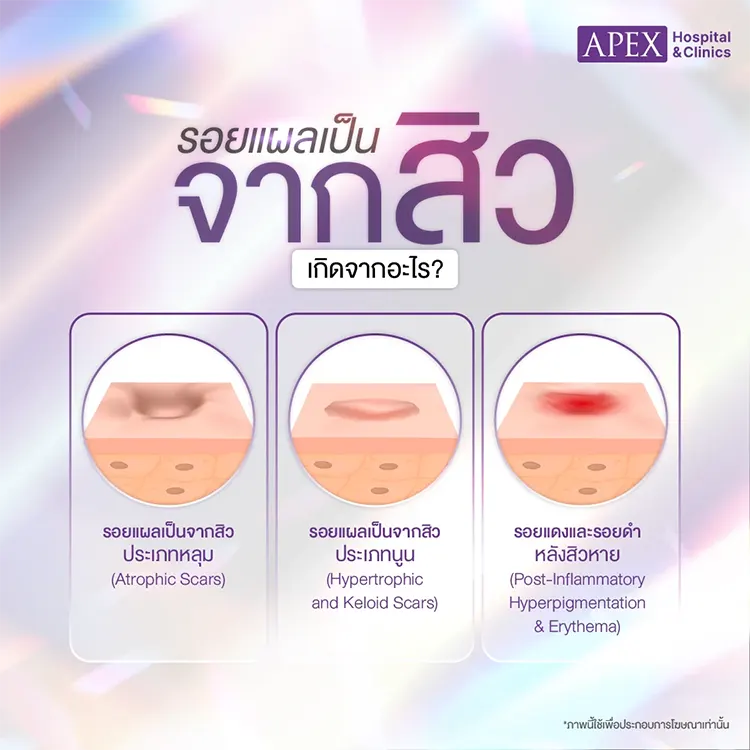 รอยแผลเป็นจากสิว