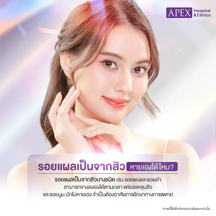รอยแผลเป็นจากสิว