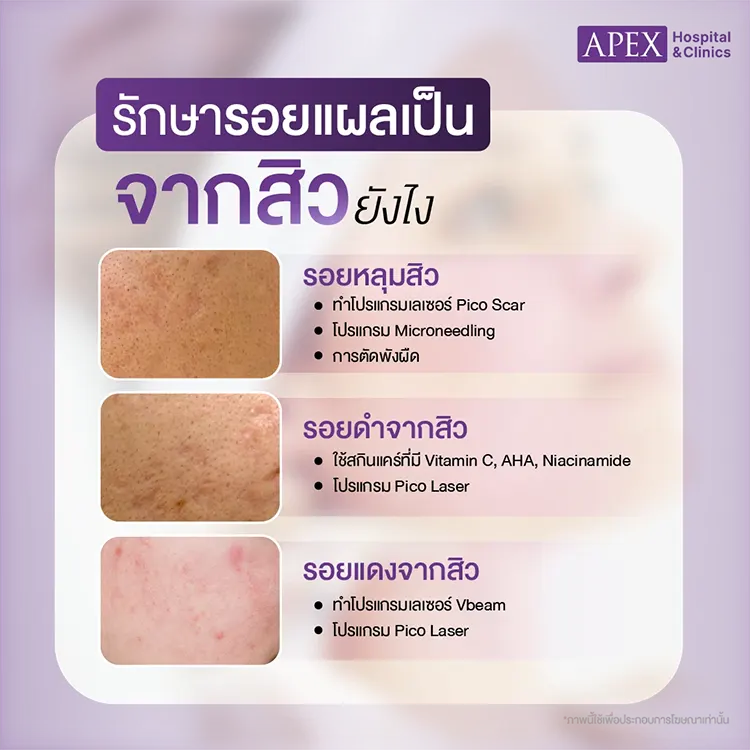 รักษารอยแผลเป็นจากสิว