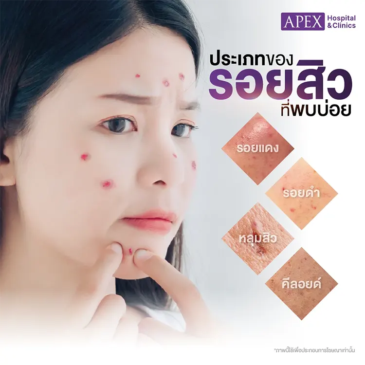 รักษารอยสิว