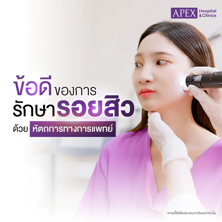 รักษารอยสิว