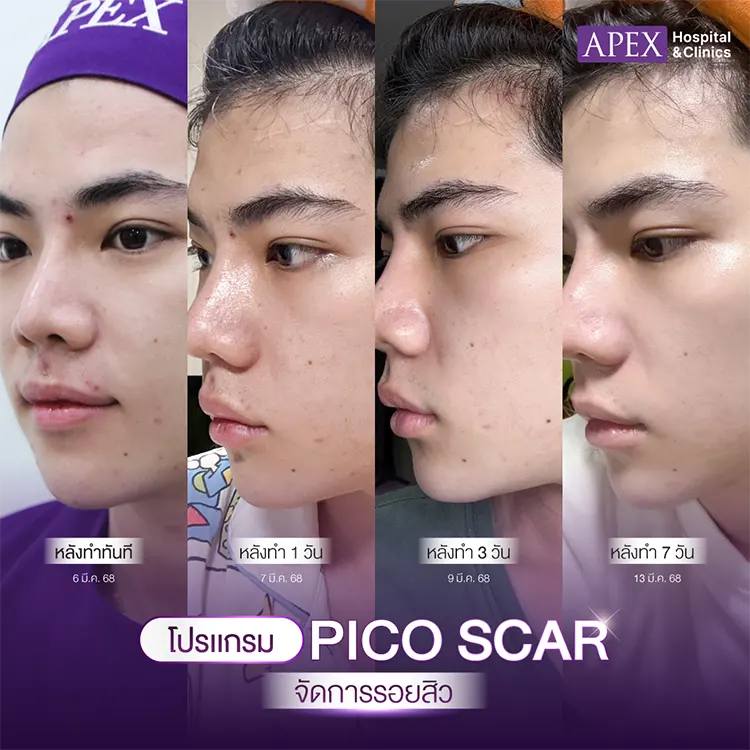 รักษารอยสิว