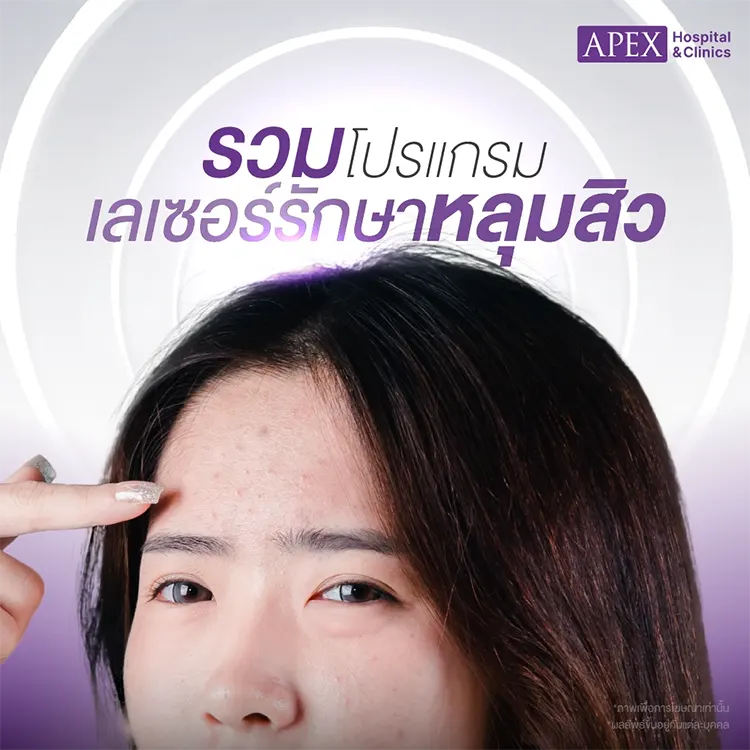 รักษาหลุมสิว