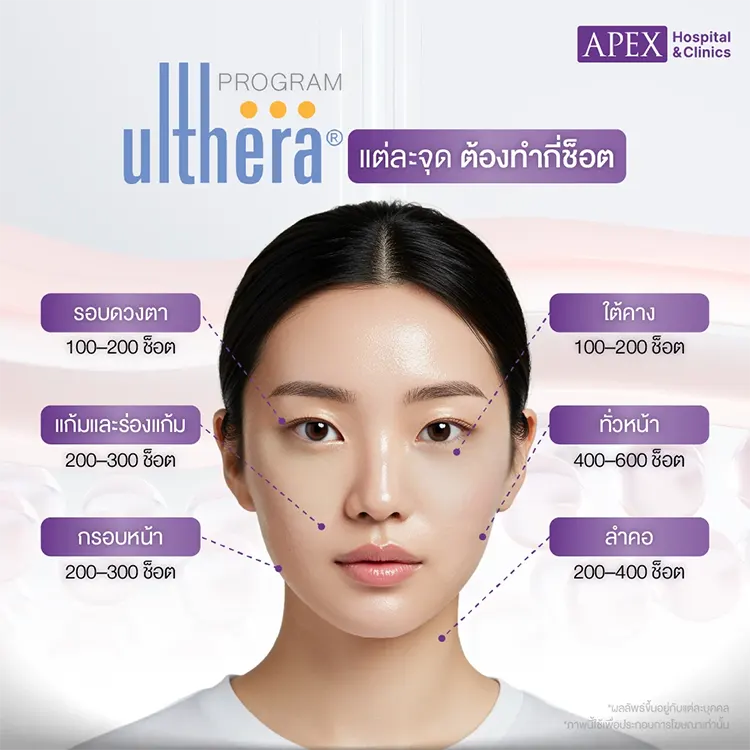 Ulthera ทั่วหน้ากี่ช็อต
