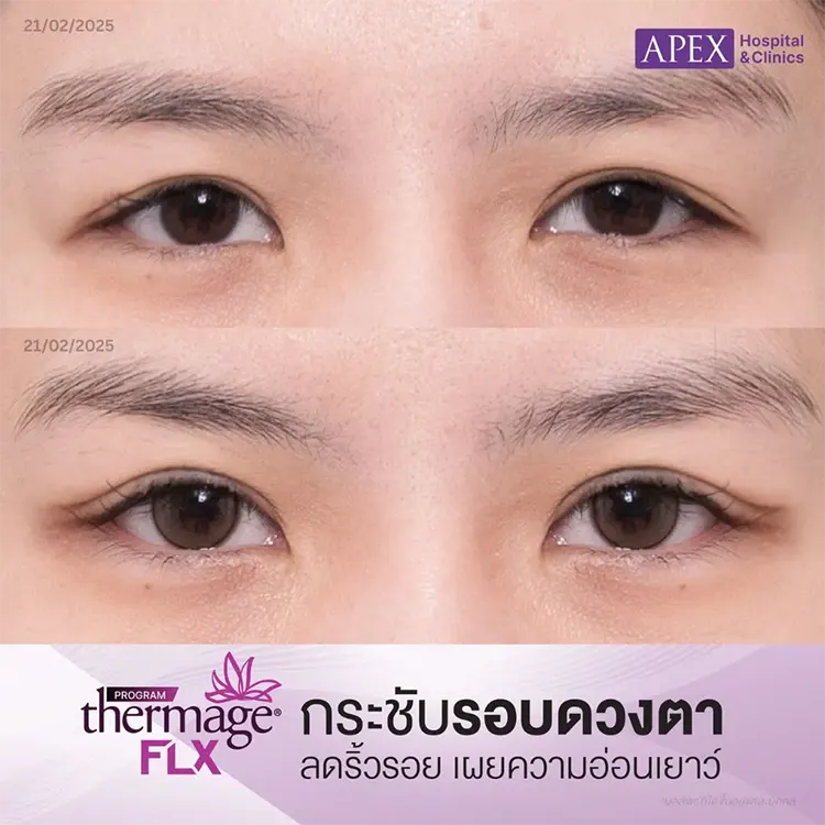 Thermage เจ็บไหม
