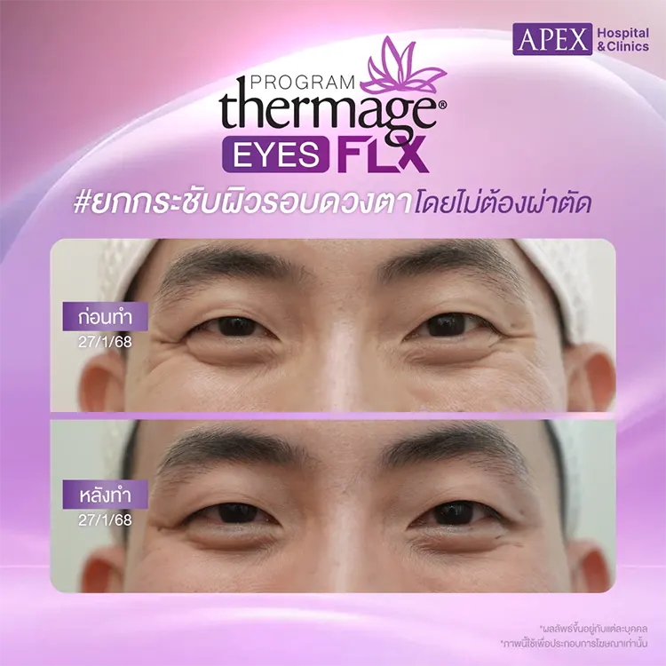 Thermage เจ็บไหม