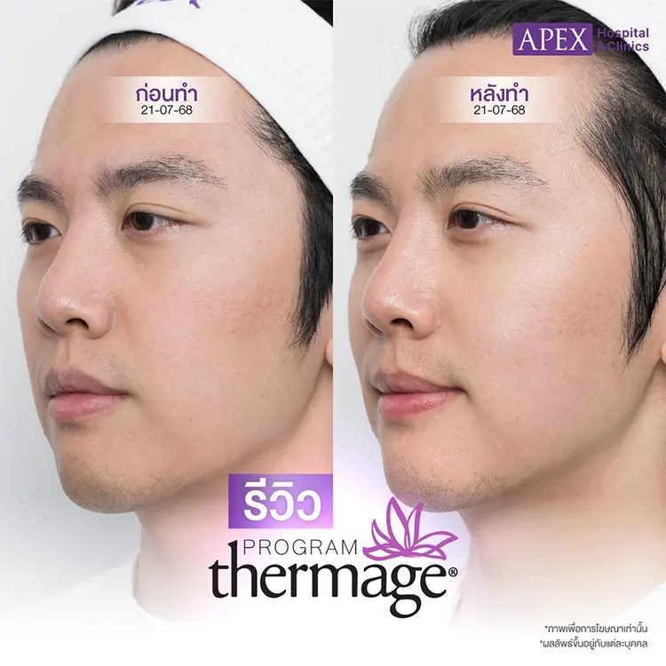 Thermage เจ็บไหม