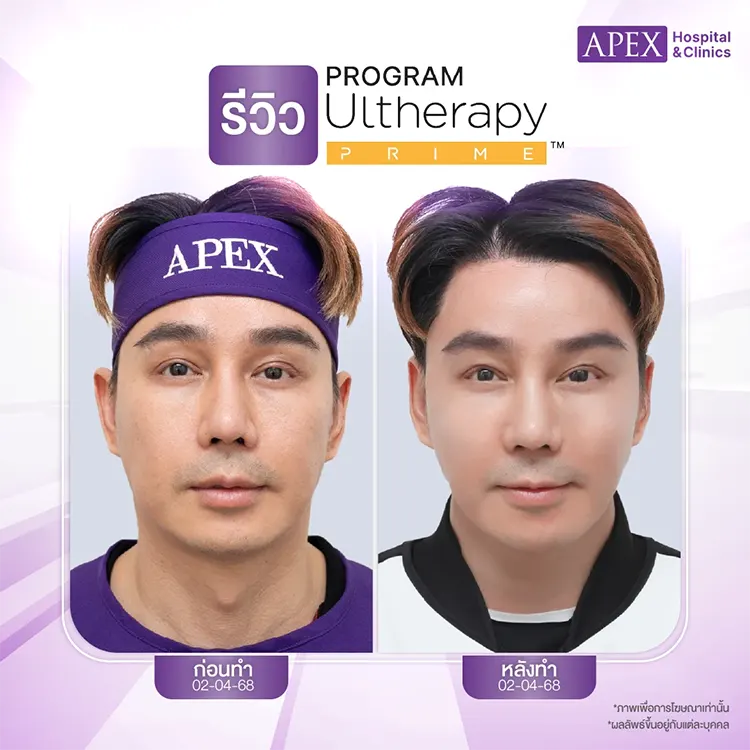 Ulthera ทั่วหน้ากี่ช็อต