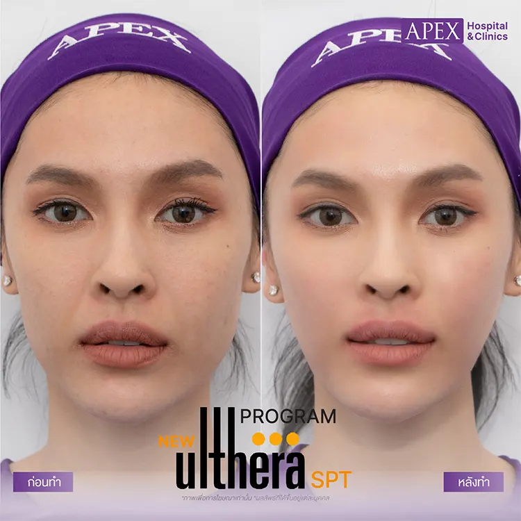 Ulthera ทั่วหน้ากี่ช็อต