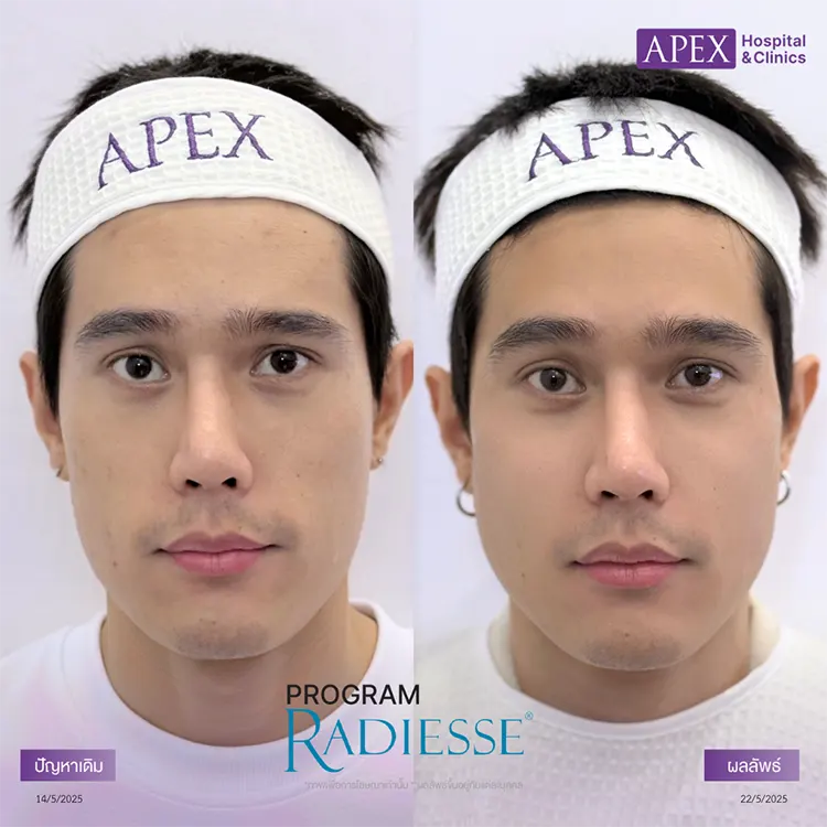 สีผิวไม่สม่ำเสมอ