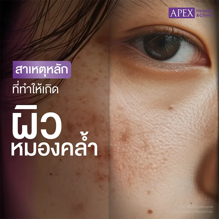 ผิวหมองคล้ำ