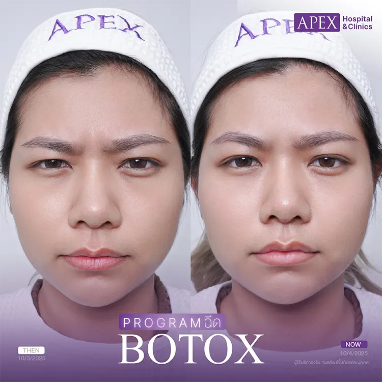 โบท็อกซ์ Dysport