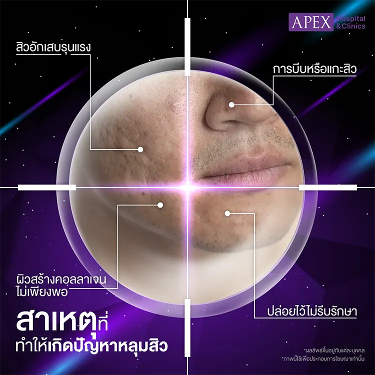 หลุมสิว