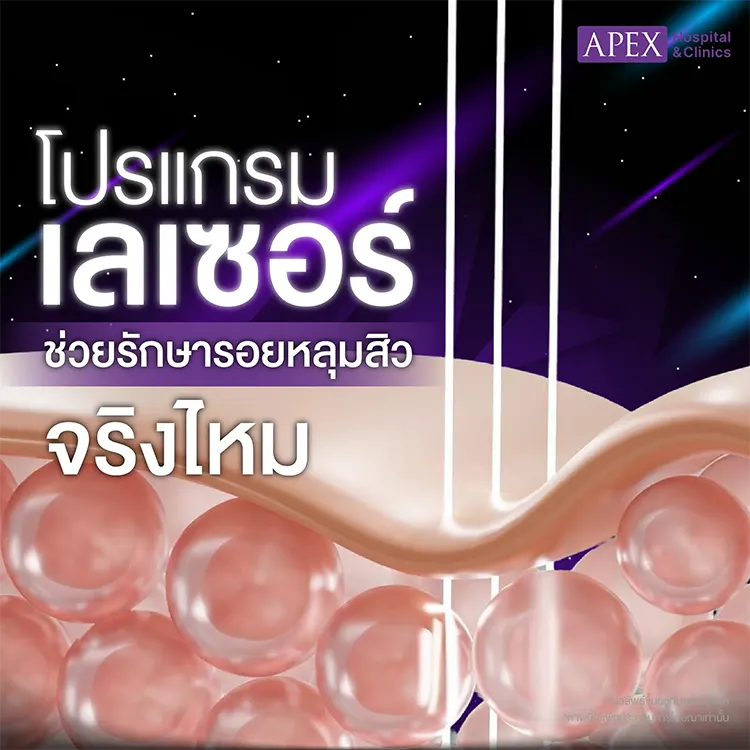 หลุมสิว