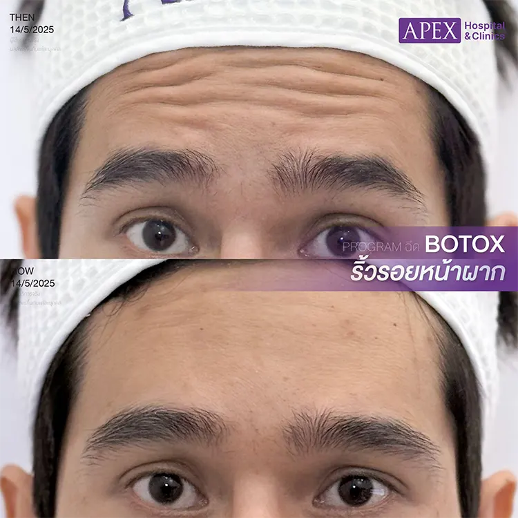 ฉีดโบท็อกซ์ที่ไหนดี