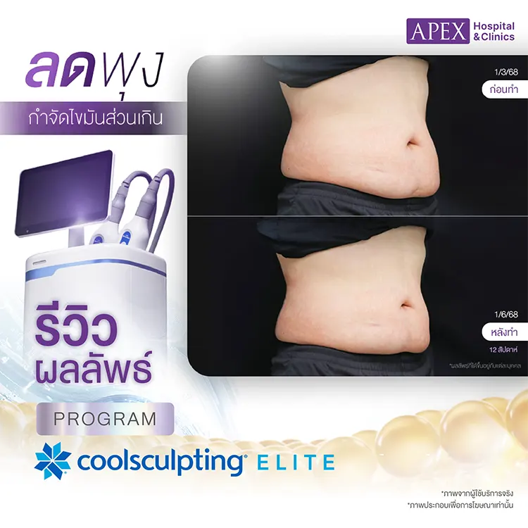 Coolsculpting ราคา