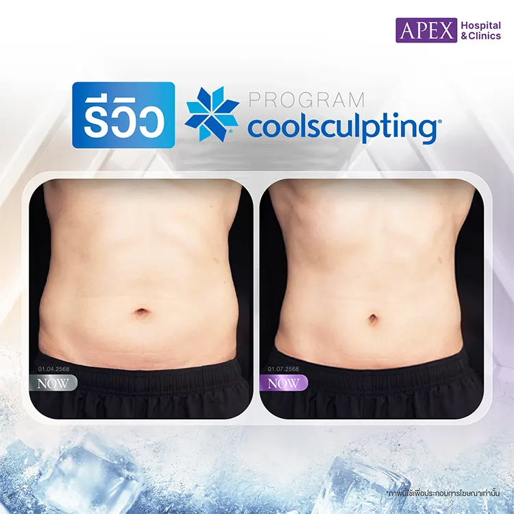 Coolsculpting ราคา