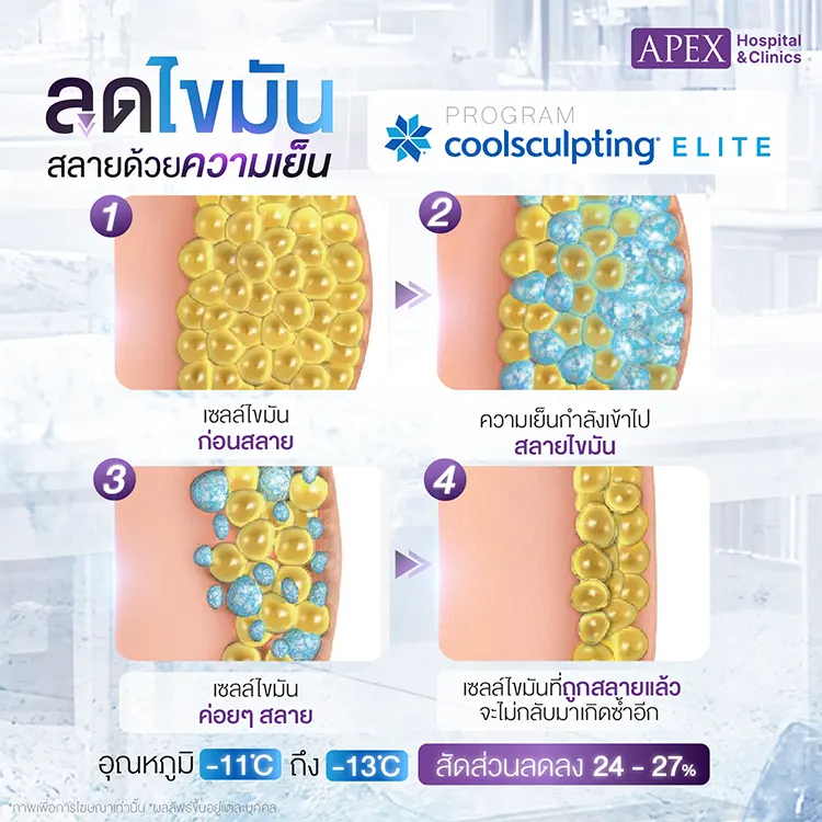 Coolsculpting ราคา