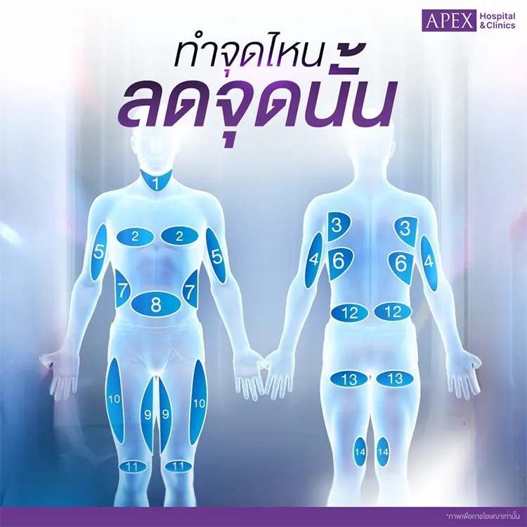 Coolsculpting ราคา