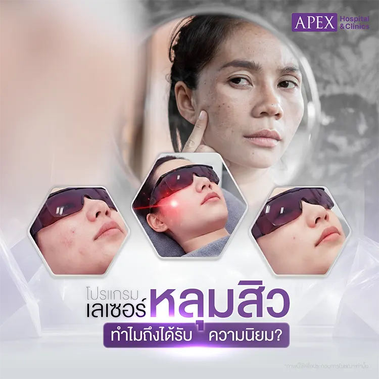 เลเซอร์หลุมสิว