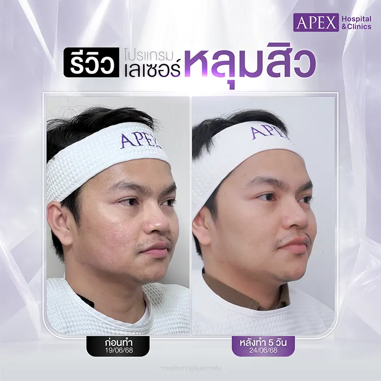 เลเซอร์หลุมสิว