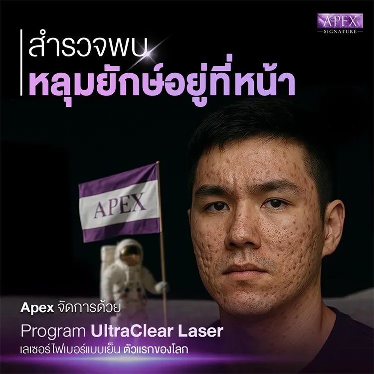 หลุมสิว