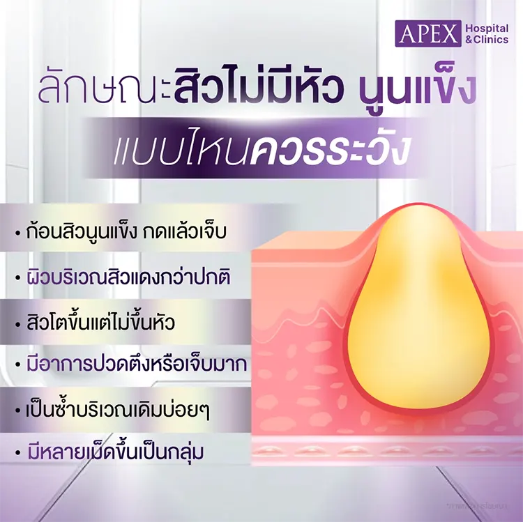 สิวไม่มีหัว