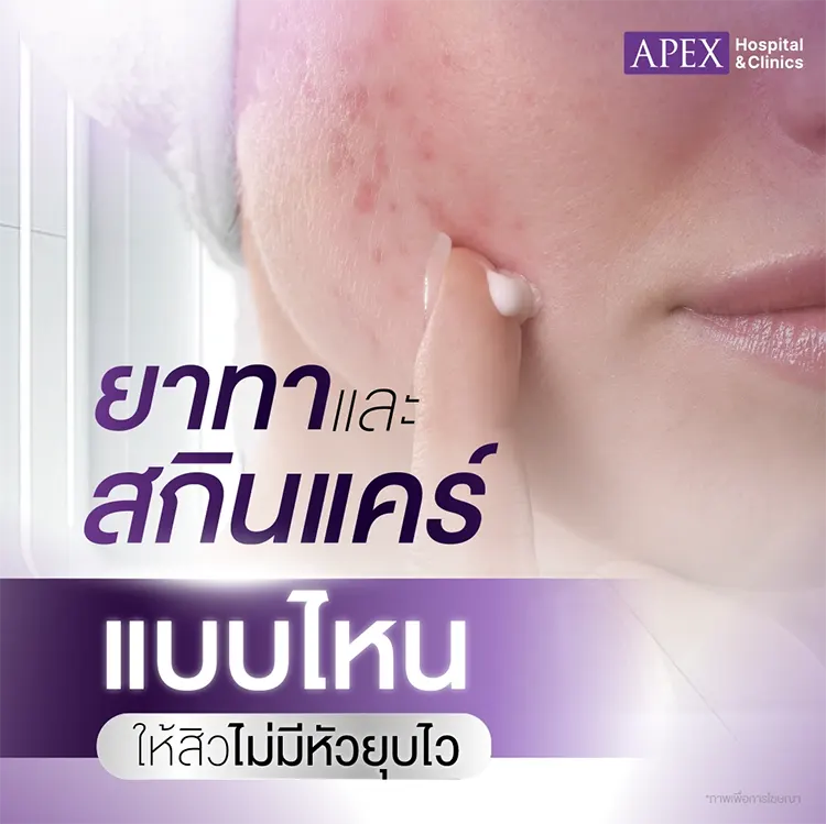 สิวไม่มีหัว