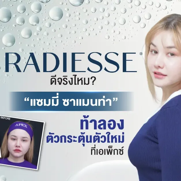 Radiesse ท้าลองดีจริงไหม (คุณแซมมี่ ซาแมนท่า)