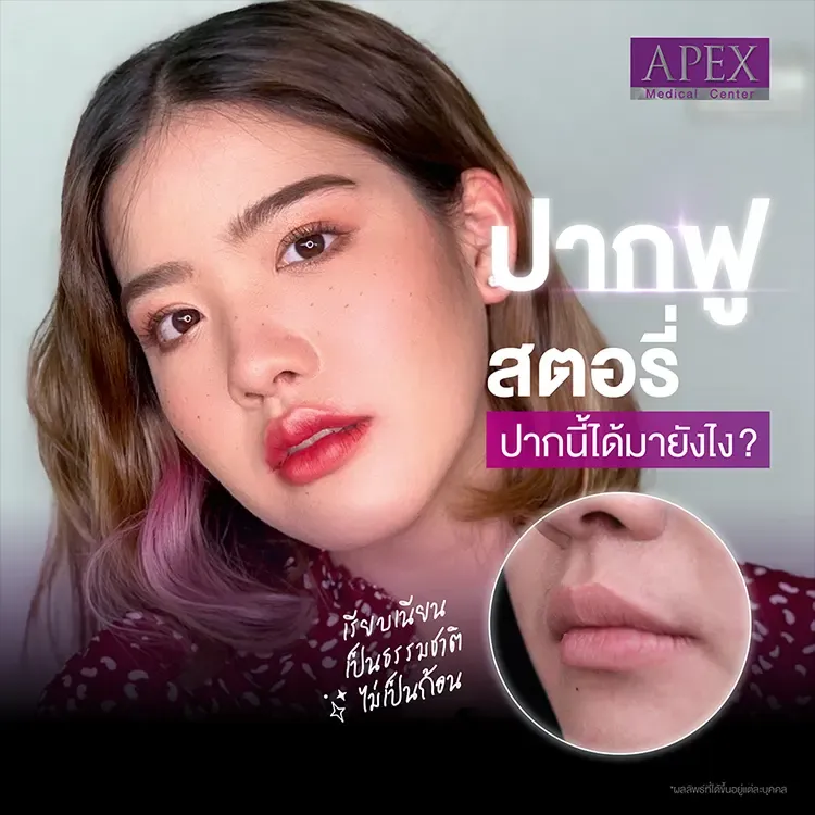 รีวิวฉีดฟิลเลอร์ปากกระจับ (คุณพัด)