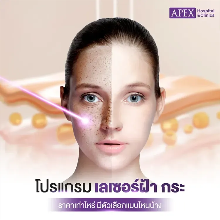 เลเซอร์ฝ้า กระ ราคาเท่าไหร่ กี่ครั้งเห็นผล เจาะลึกเลเซอร์ช่วยอะไร