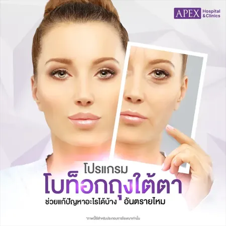 โบท็อกถุงใต้ตา คืออะไร ราคาเท่าไหร่ กี่ครั้งเห็นผล