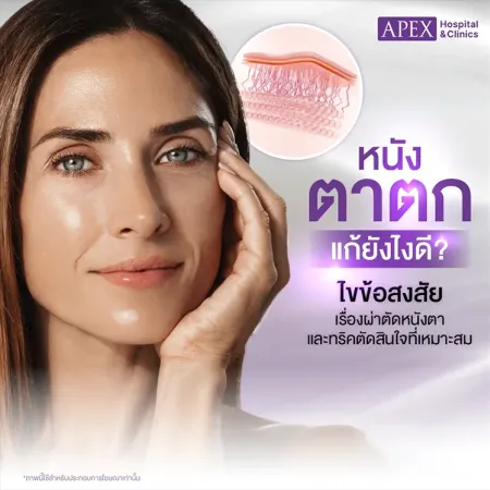 หนังตาตก คืออะไร ต้องผ่าตัดไหม รู้ก่อนตัดสินใจแก้ทรงตา
