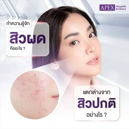 สิวผด คืออะไร เกิดจากสาเหตุ แตกต่างจากสิวปกติอย่างไร