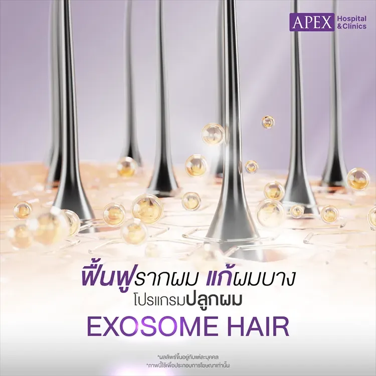ปลูกผม Exosome Hair คืออะไร ฟื้นฟูรากผม แก้ปัญหาผมร่วงผมบาง