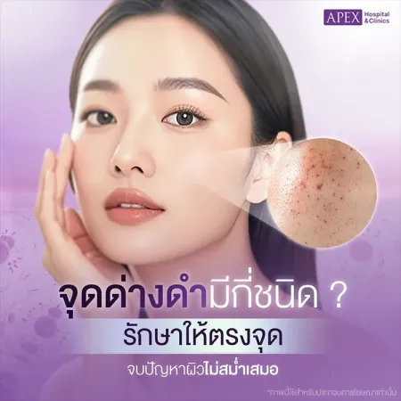 จุดด่างดำ คืออะไร สาเหตุเกิดจาก มีวิธีรักษาป้องกันอย่างไร