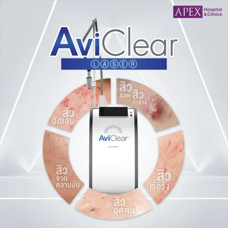 วิธีรักษาสิวด้วย AviClear Laser VS Accure Laser ต่างกันยังไง