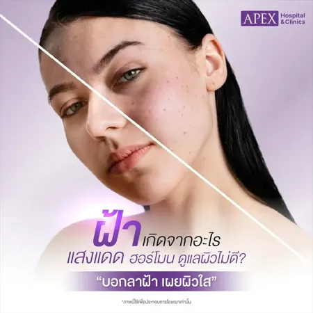 เป็นฝ้า เกิดจากสาเหตุ วิธีรักษาและป้องกันไม่ให้ฝ้ากลับมาอีก