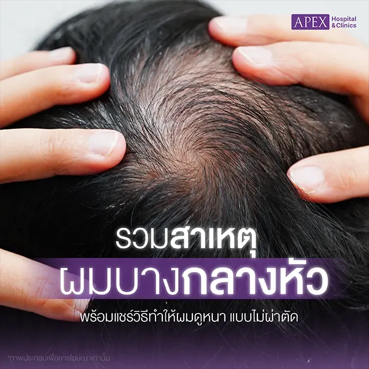 ผมบางกลางหัว เกิดจากสาเหตุอะไร มีสัญญาณเตือนอย่างไร