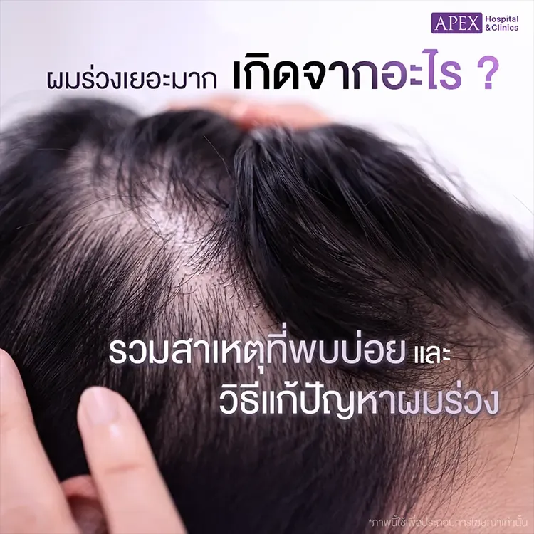 ผมร่วงเยอะมาก เกิดจากสาเหตุอะไร มีสัญญาณเตือนอย่างไร